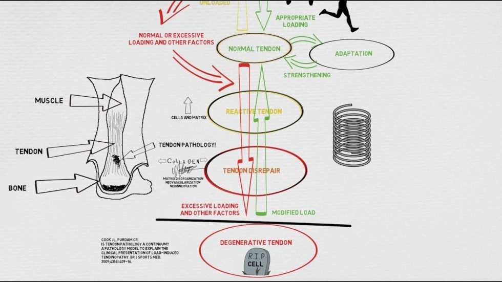 Tendinopatías, ¿sabes cómo debes tratarlas? Fisiofitness Bilbao